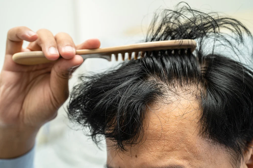 chute de cheveux homme
