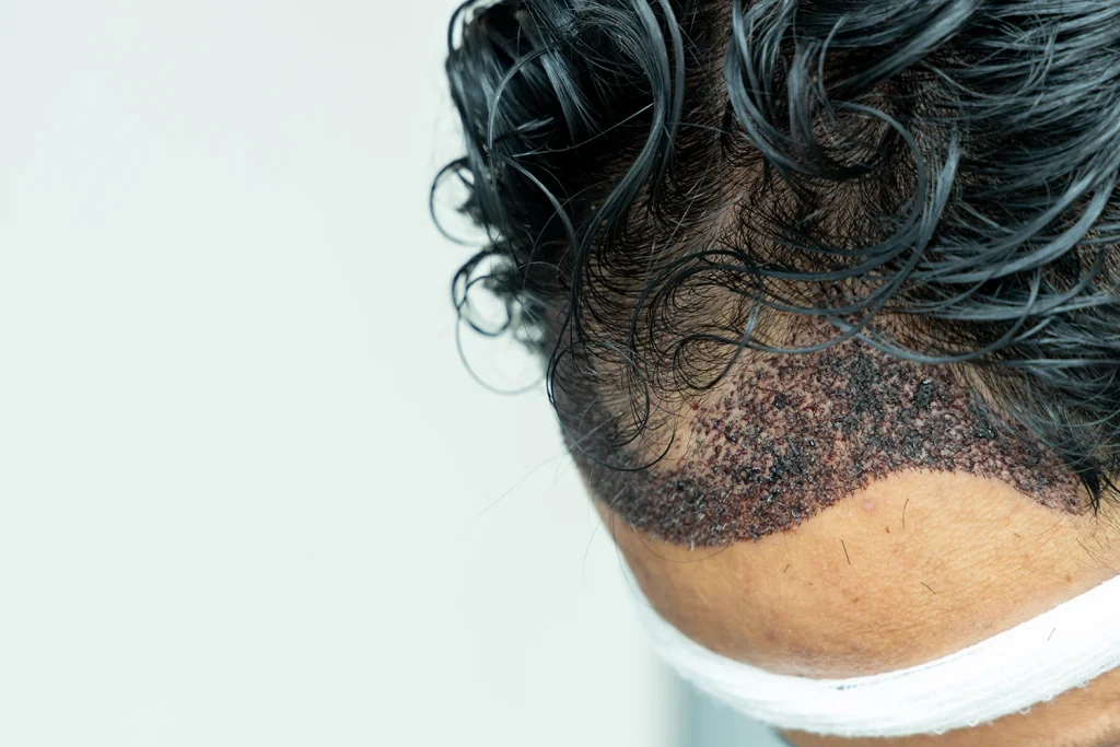 Les principales techniques de greffe capillaire pour les hommes