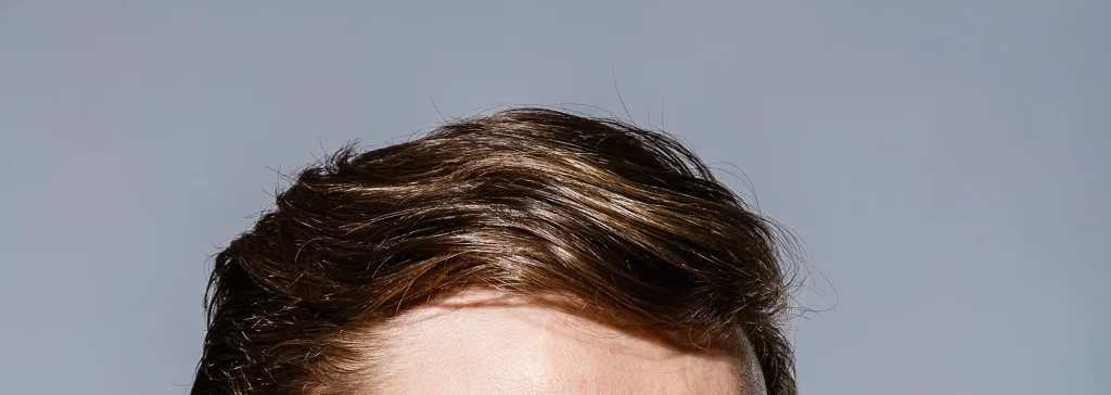 Greffe de cheveux